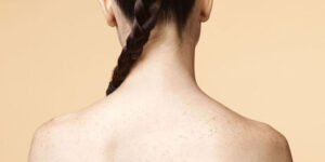 acne-espalda-causas-prevencion