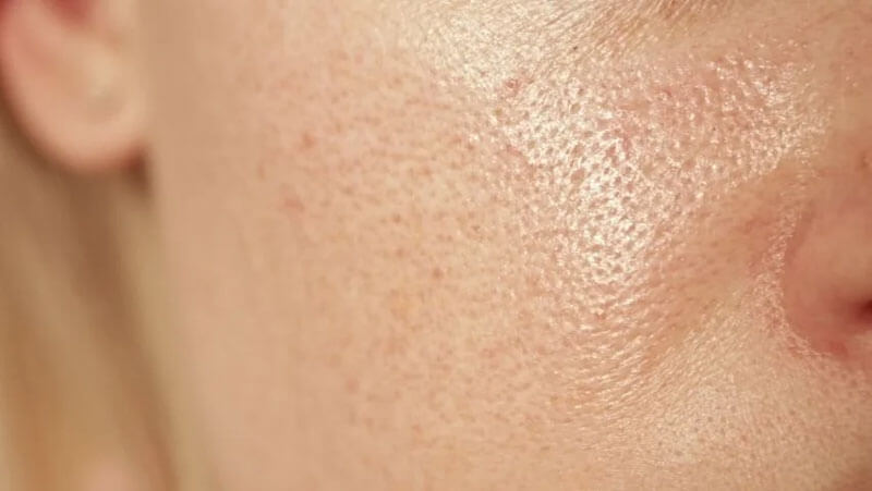 poros-dilatados-causas-prevencion