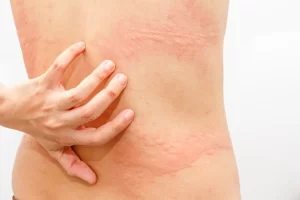 dermatitis-para-adultos