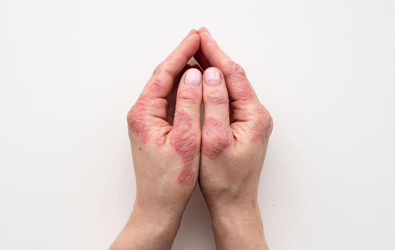 psoriasis-causas-sintomas